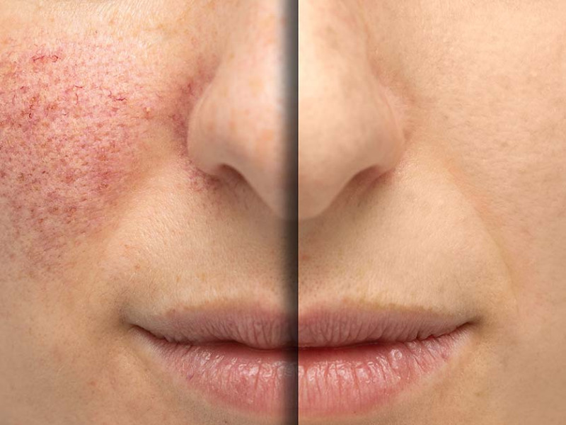 Discover IPL Photorejuvenation for Wrinkle-Free and Spotless Skin at Dr. Caroline Carbasse at Estetica Javea