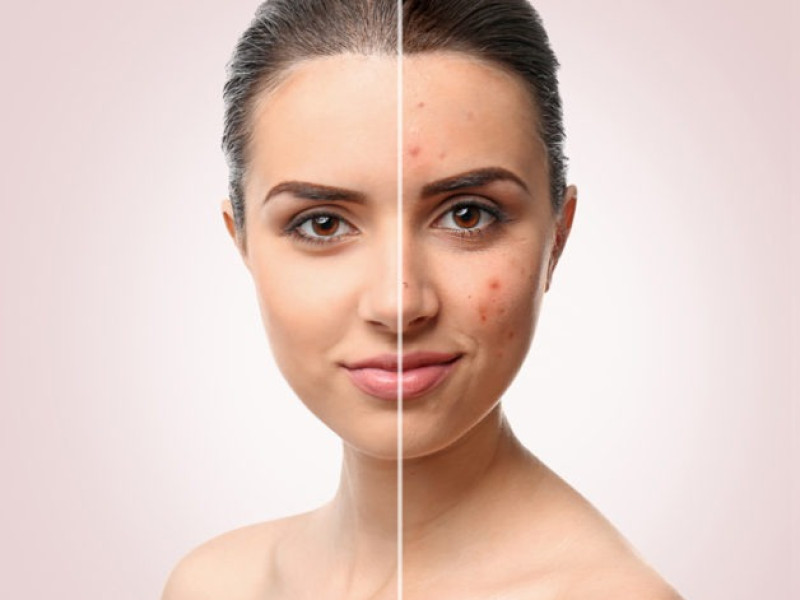 Acne Treatment with IPL at Estetica Javea: Regain Healthy and Radiant Skin