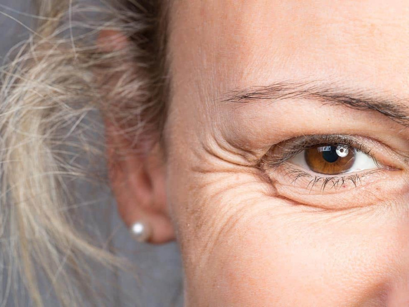 Botox in Crow's Feet in Javea: Precise Treatment for a Youthful Look