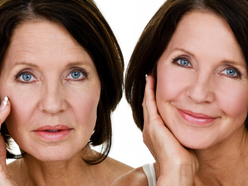 Facial Rejuvenation in Javea with Dr. Caroline Carbasse: Non-Surgical Mini Facelifts