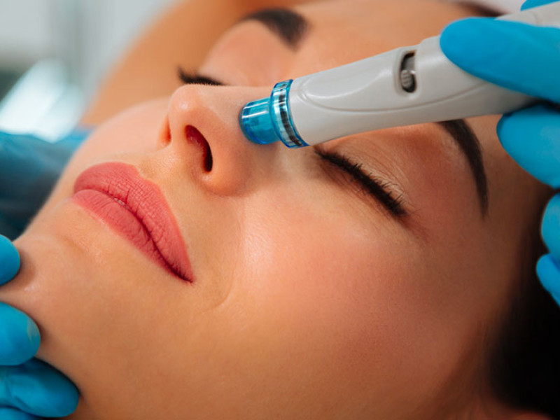HydraFacial in Javea: Innovative 4-in-1 Facial Treatment | Estetica Javea