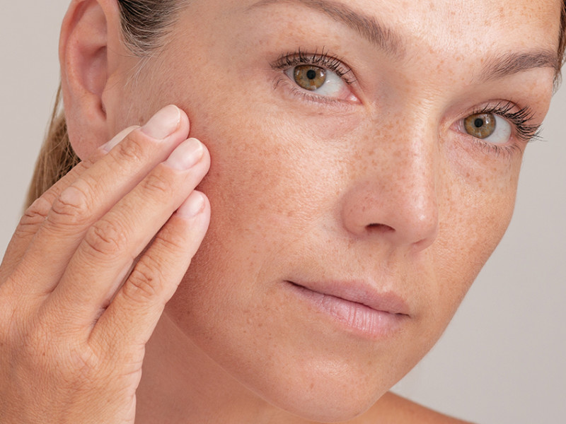 IPL Treatment at Estetica Javea: Eliminating Veins and Spots for Radiant Skin