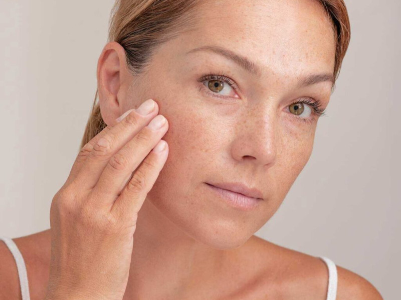 Say Goodbye to Spider Veins and Spots with IPL Treatment at Dr. Caroline Carbasse in Estetica Javea